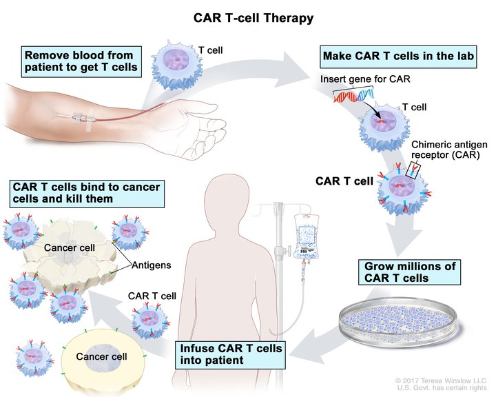 In CAR T-cell therapy, blood is drawn from a patient to gather their T cells. The CAR gene is added to their T cells in the lab and then more CAR T cells are grown and infused into the patient for treatment.