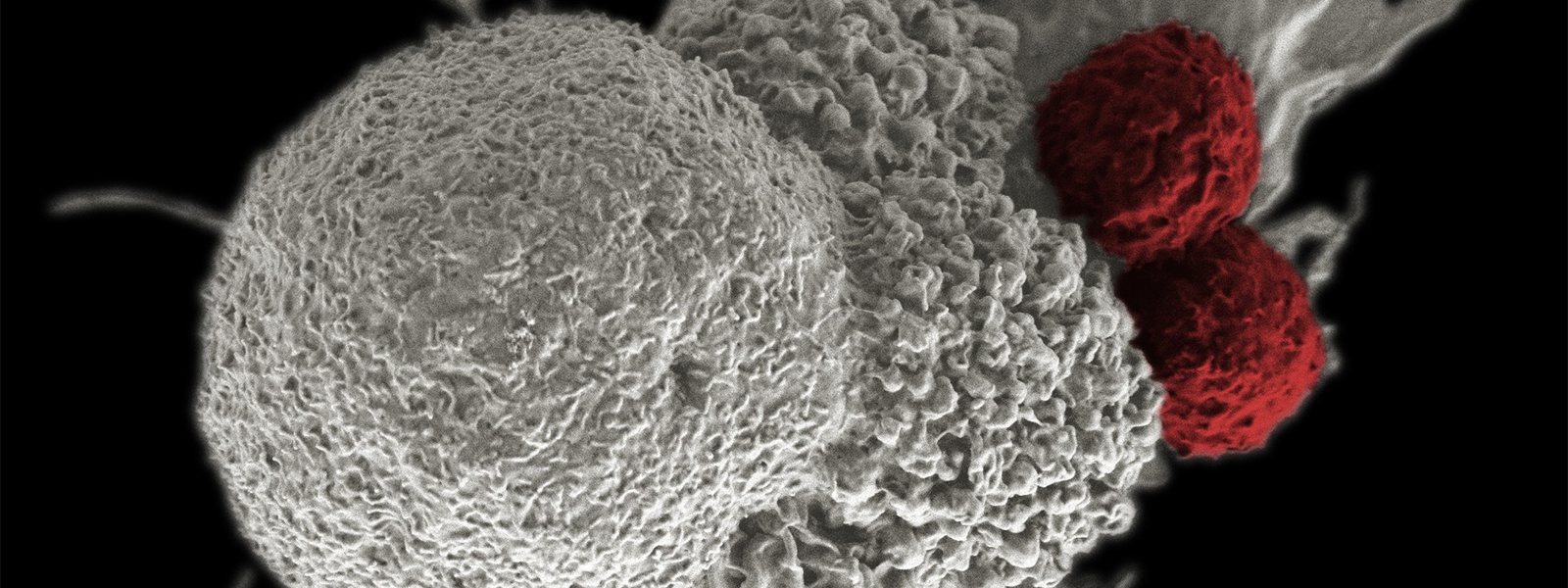 T cells (red) attack an oral squamous cancer cell (white)