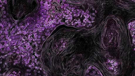 KRAS in lung cancer. Purple microscopy image.